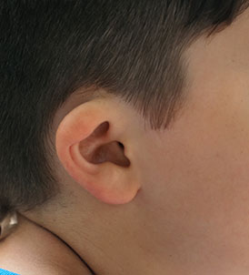 Ear reconstruction